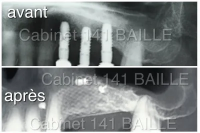 ROG avant implant a marseille