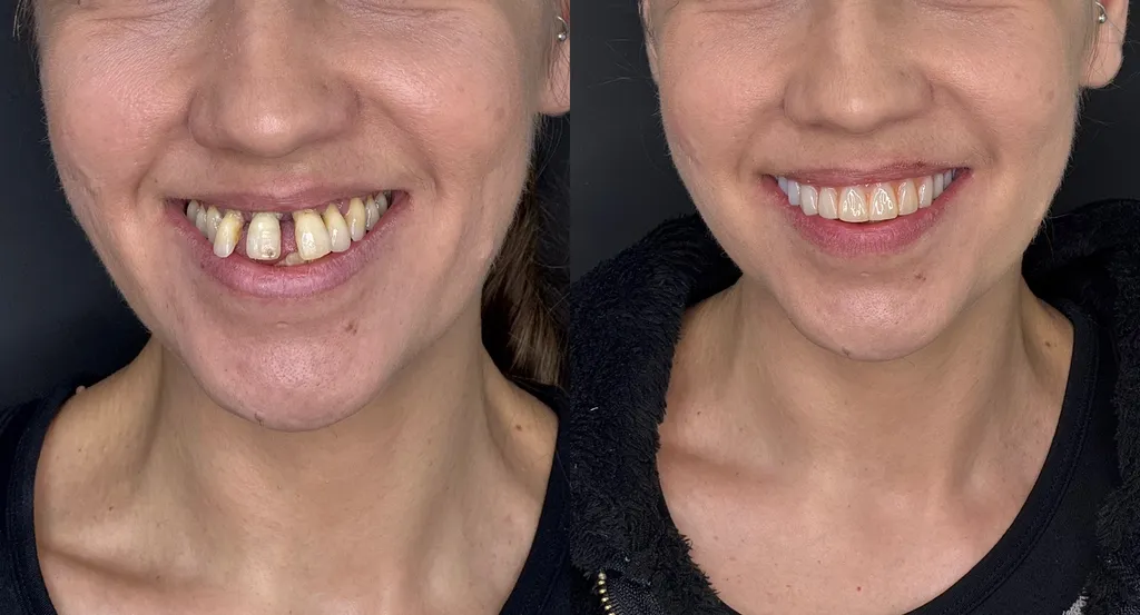 avant apres ALL ON 6  all on 4 Marseille par specialiste en implantologie.