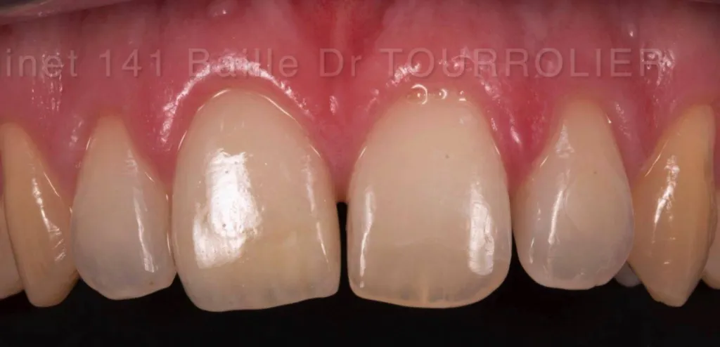 Facettes dentaires Marseille 13005