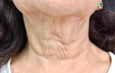 Relâchement cutané du cou avec l’âge : la radiofréquence INDIBA® au centre expert DERMA SUD Castanet-Tolosan, proche de Toulouse