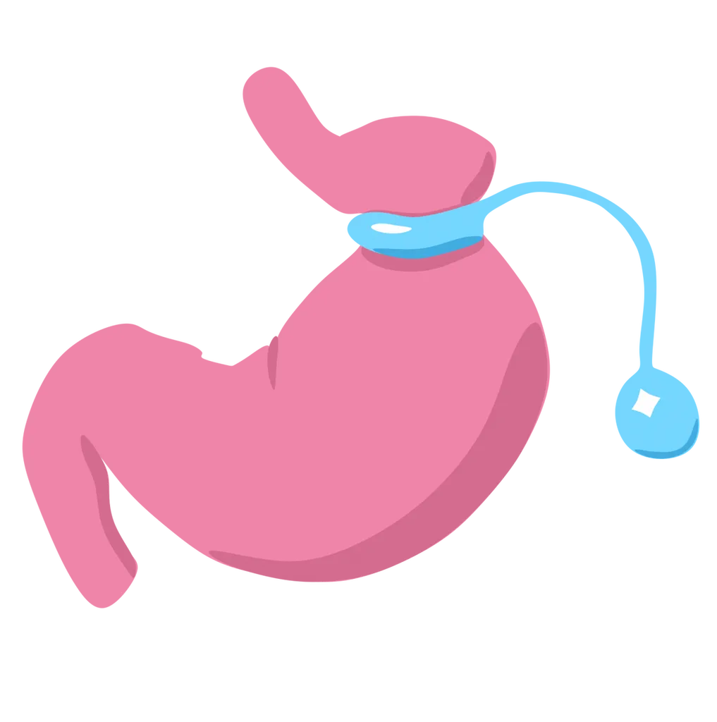 anneau gastrique