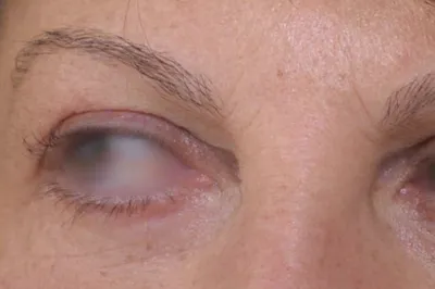 Blépharoplastie à Lyon : rajeunir et éclairer le regard avec le Dr Jean-François Pascal