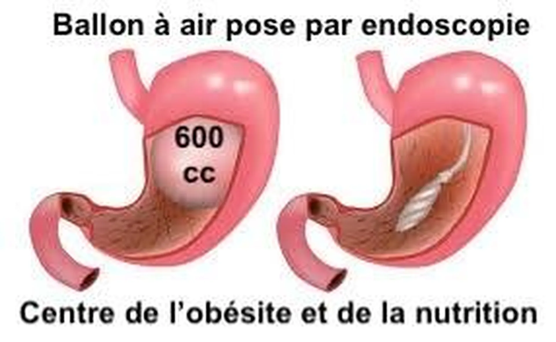 ballon gastrique à eir