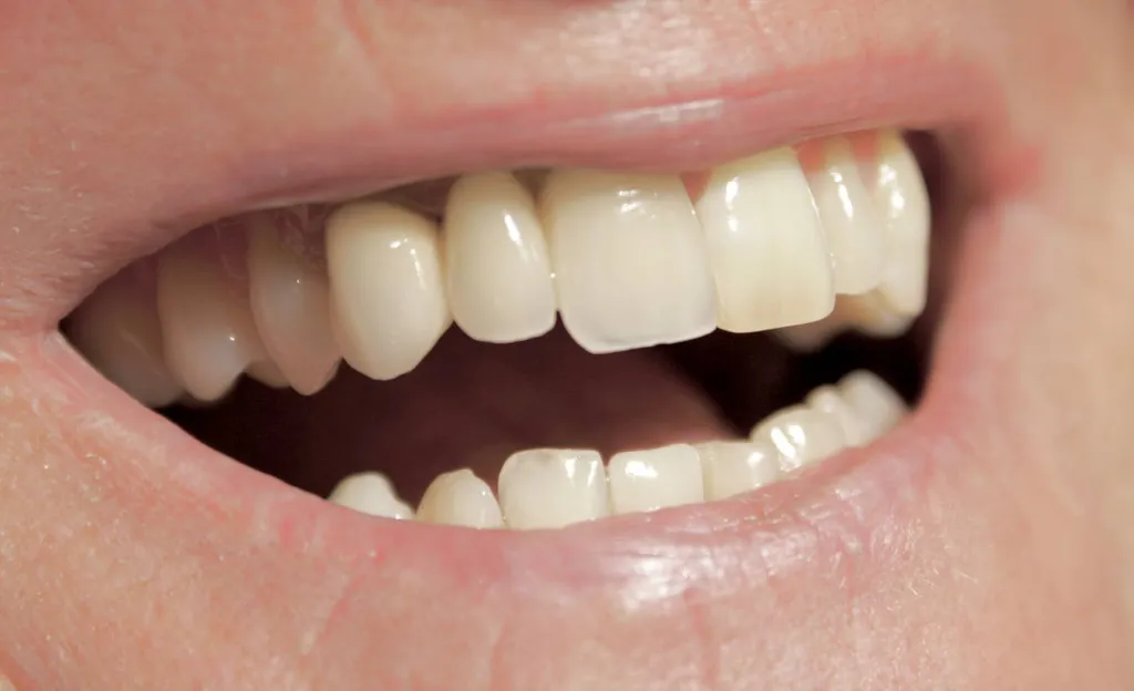 Pourquoi mes gencive me font-elles mal. Dr Tourrolier Philippe 13016 Marseille