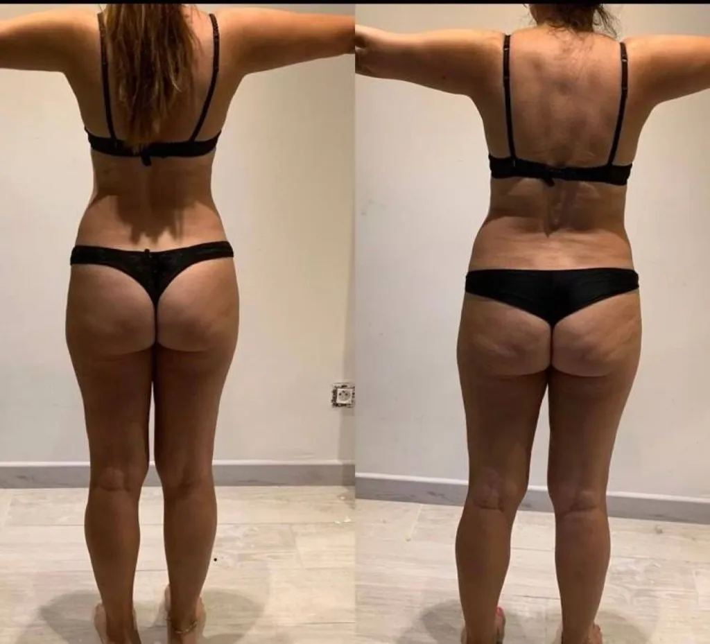 perte de poids cellulite coach privé electrostimulation 