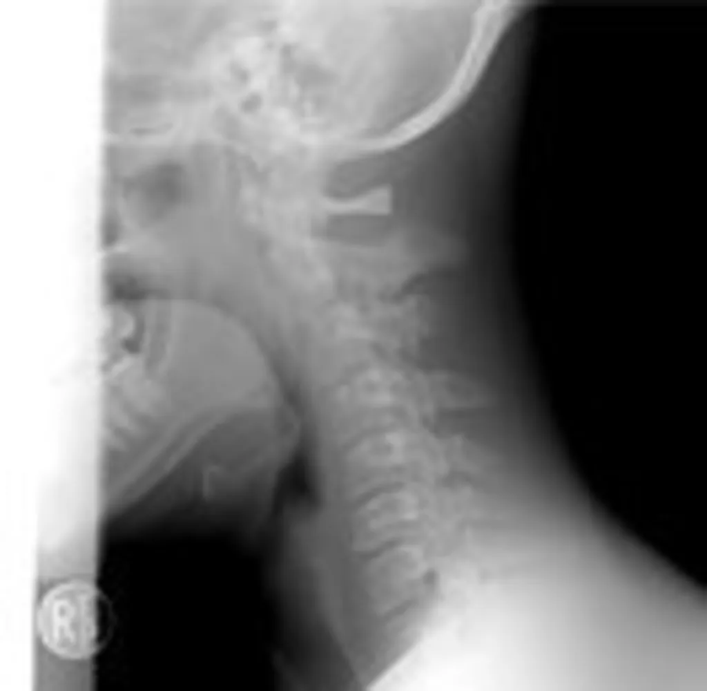 L'indemnisation du traumatisme cervical suite à un accident de la route par la Cour d'Appel d'Aix en Provence