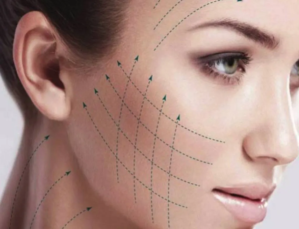 fils tenseurs Radiesse sculptra profhilo structura