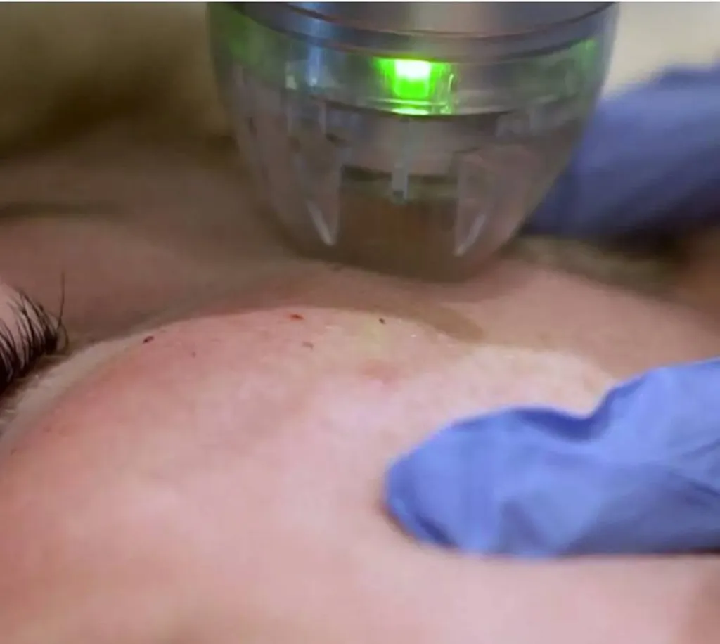 morpheus endymed radiofrequence relâchement profhilo