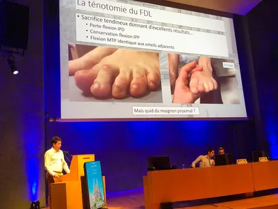 Le Docteur Julien Beldame présente sa communication sur les connections inter tendineuses au congrès de l'Association Française de Chirurgie du Pied (AFCP)