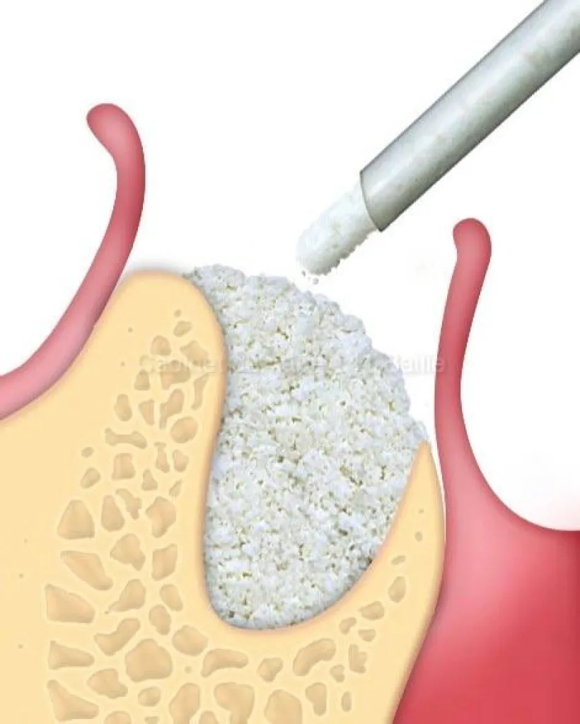 pose d'implant dentaire et greffe d'os simultannée