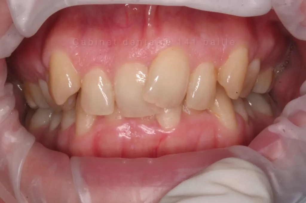 Dents plus blanches avec invisalign cabinet dentaire baille docteur didier Tourrolier