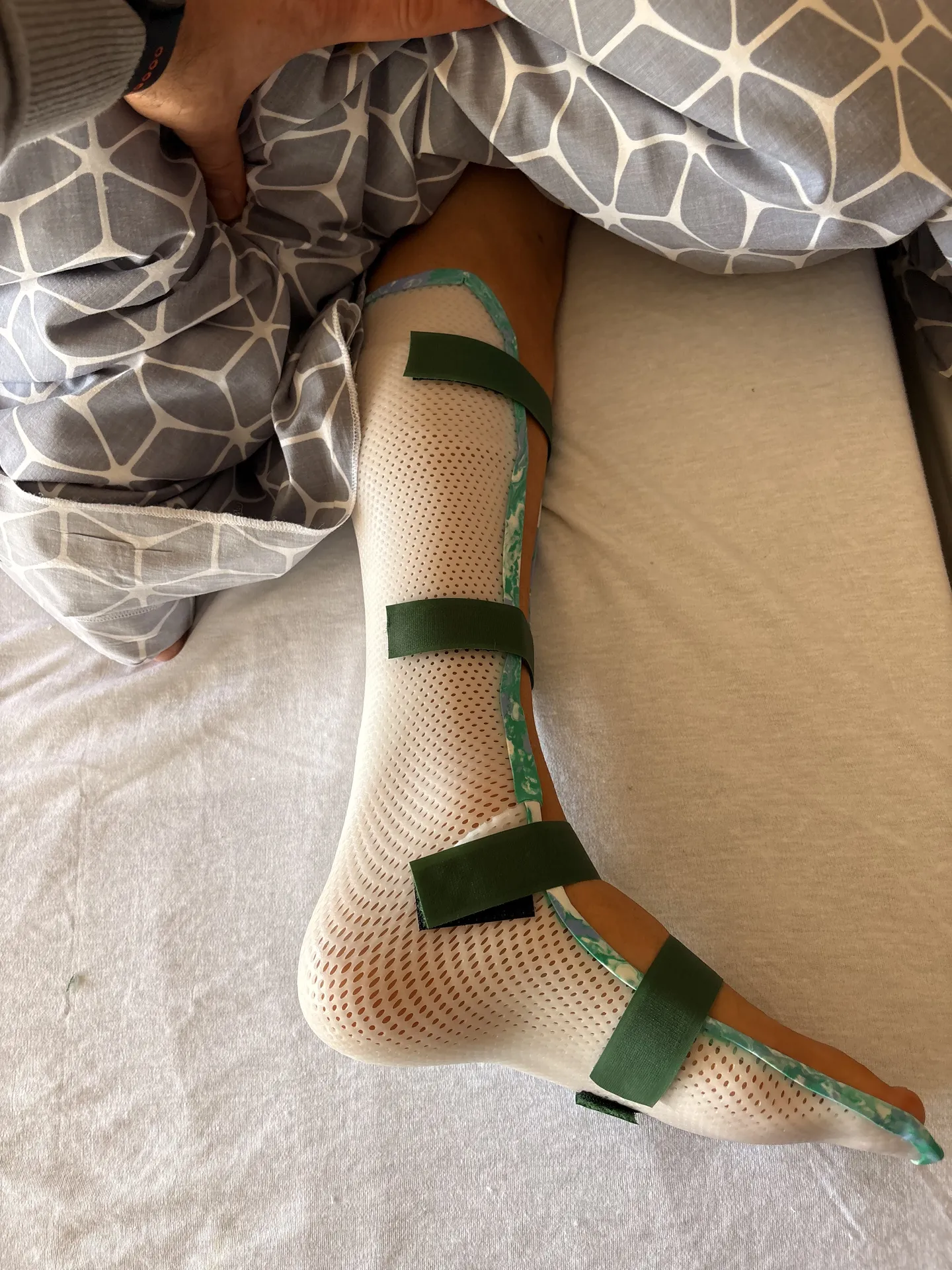 Orthese de pied sur mesure en postop 