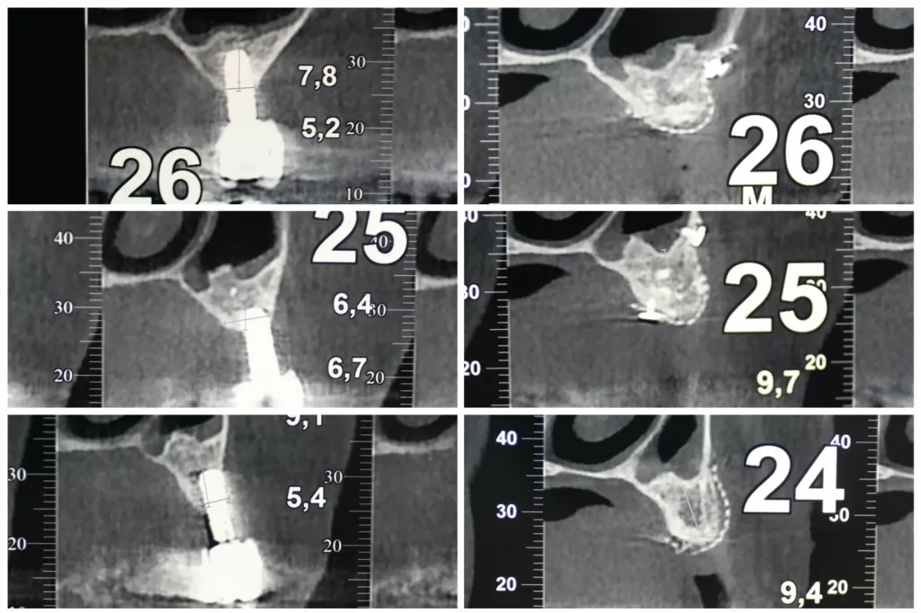 greffe implant dentaire Marseille