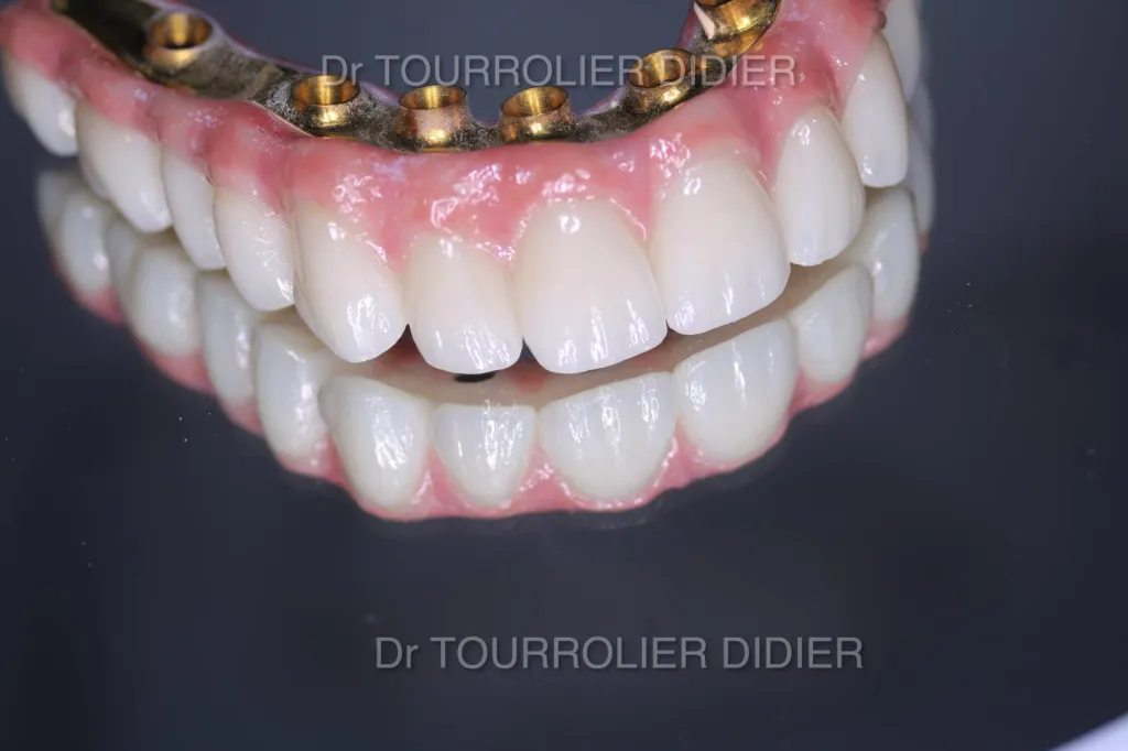 Prix implants dentaires par spécialiste à marseille