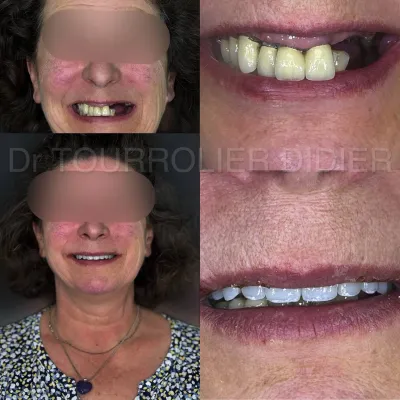 specialiste technique all on 6 dr TOURROLIER didier