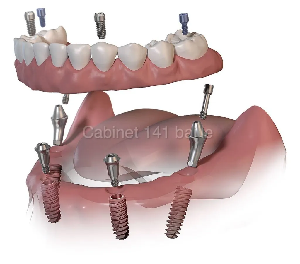 Implant Bouche Complete Marseille Prix-Cabinet d'implantologie 141 Baille.