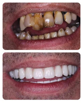 spécialiste implants bouche complete Marseille