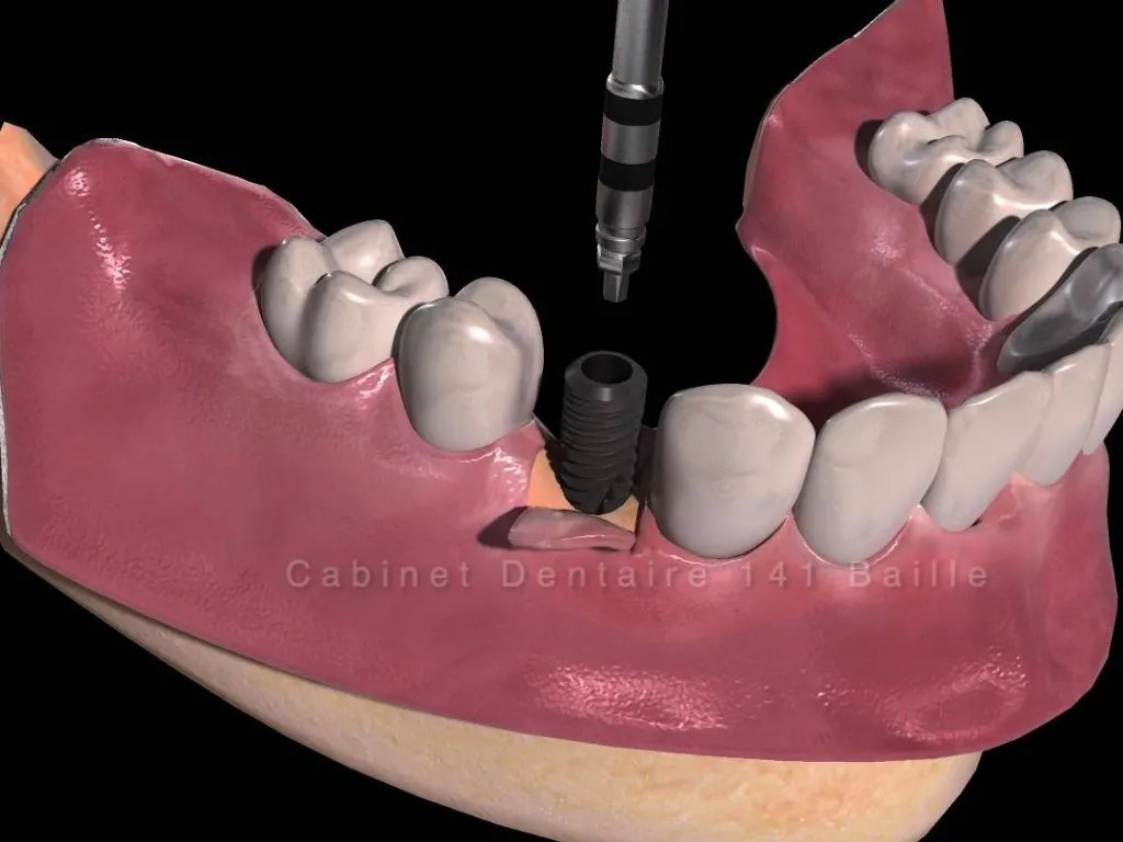 mise en place implant dentaire cabinet 141 baille Marseille