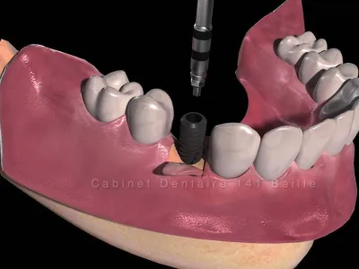 mise en place implant dentaire cabinet 141 baille Marseille