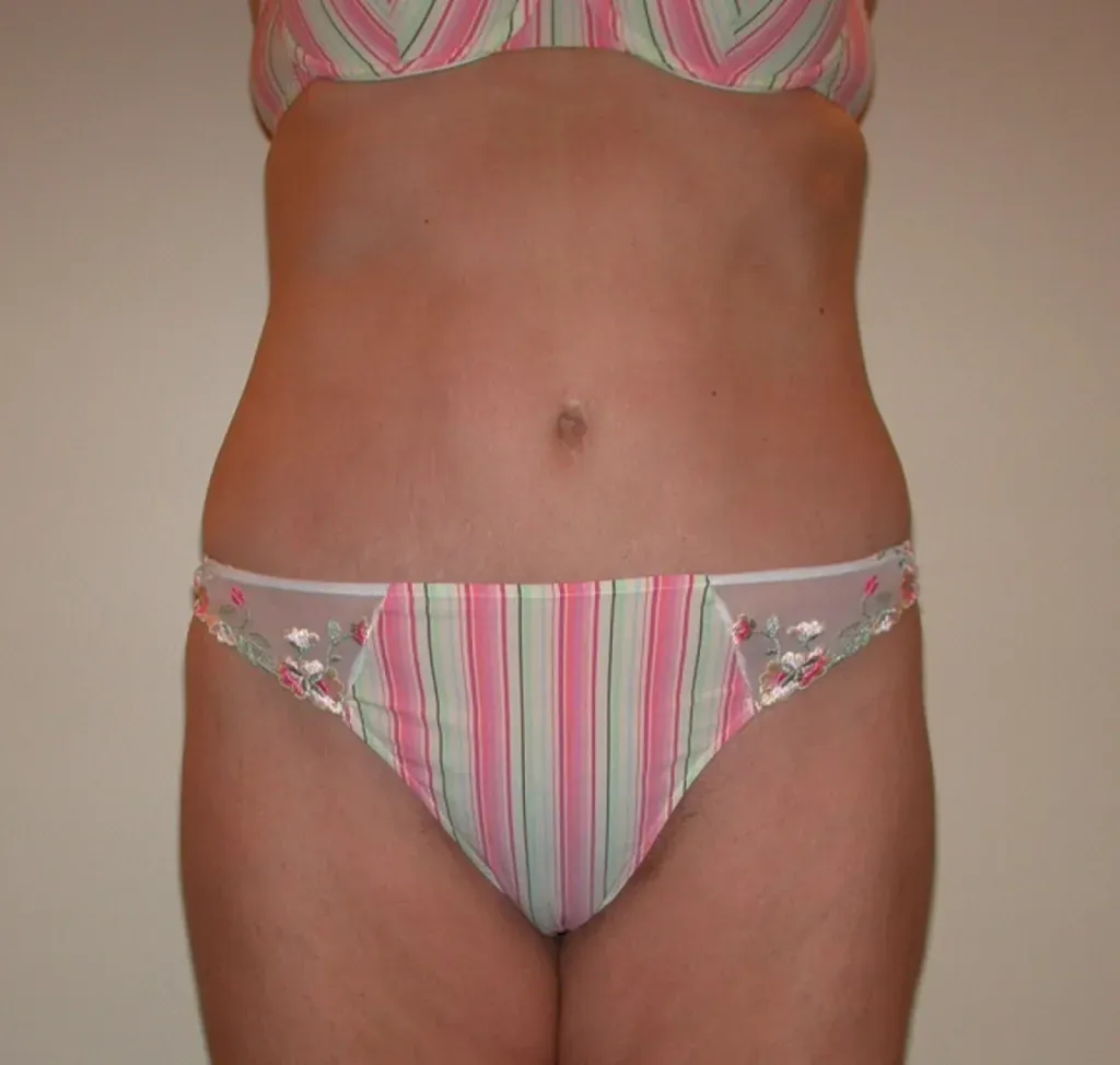 Mega-liposuction in France: international expertise with Dr Jean-François Pascal in Lyon