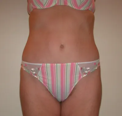 Mega-liposuction in France: international expertise with Dr Jean-François Pascal in Lyon