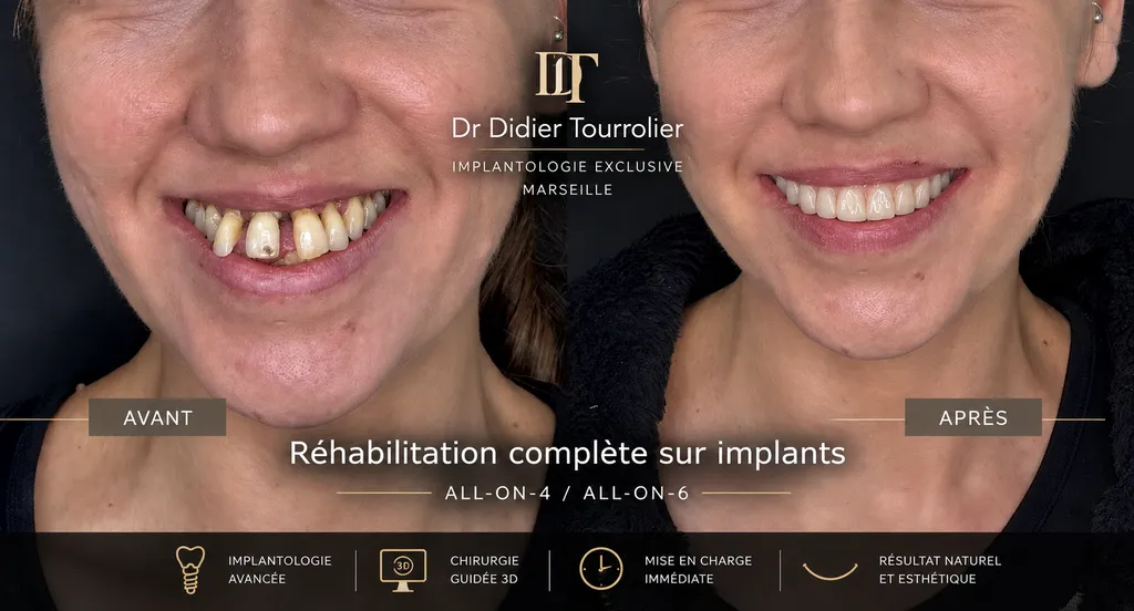 Réhabilitation complète sur implants • All-on-4 / All-on-6