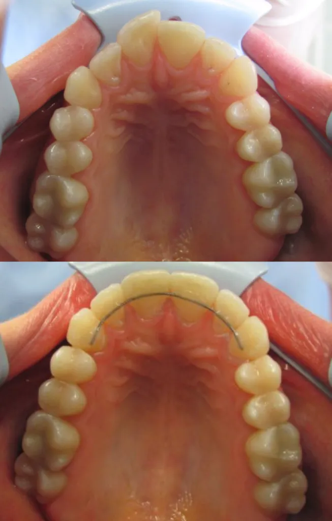 cas invisalign