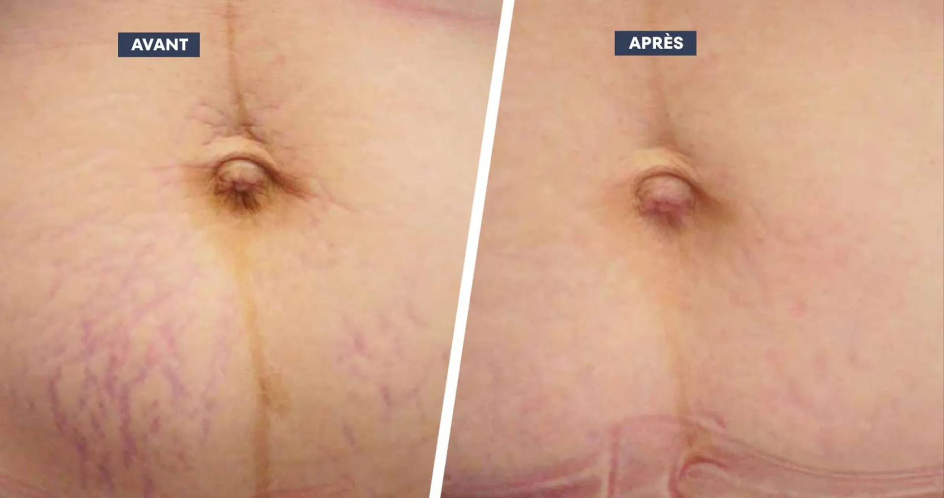 Laser ProDeep Corps à Aix-en-Provence : relachement cutané, cicatrices, vergetures