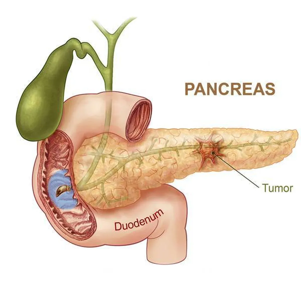 cancer du pancreas