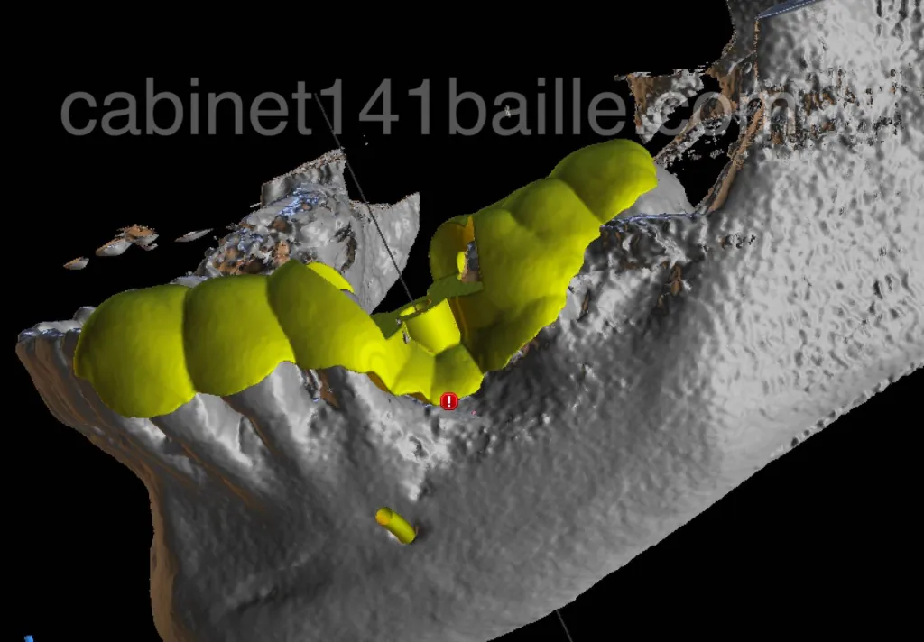 Guide implantaire par spécialiste en implantologie