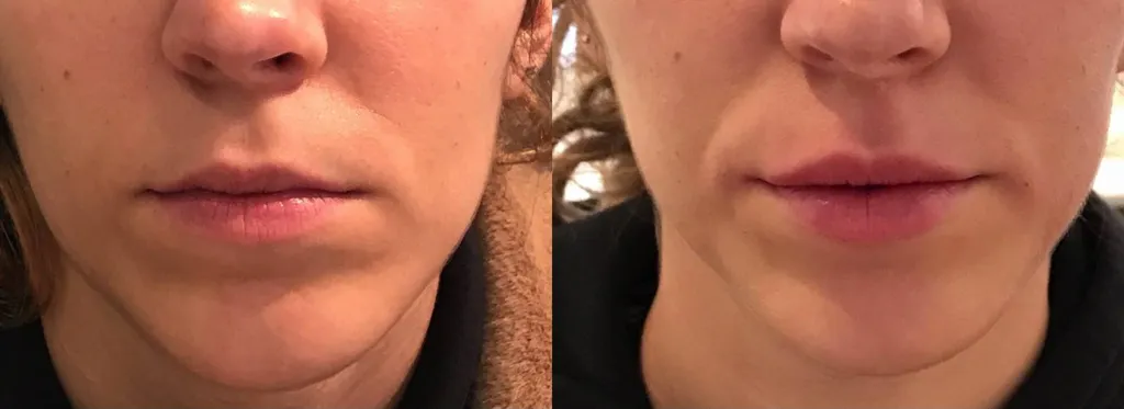 injection acide hyaluronique lèvres paris médecine esthétique