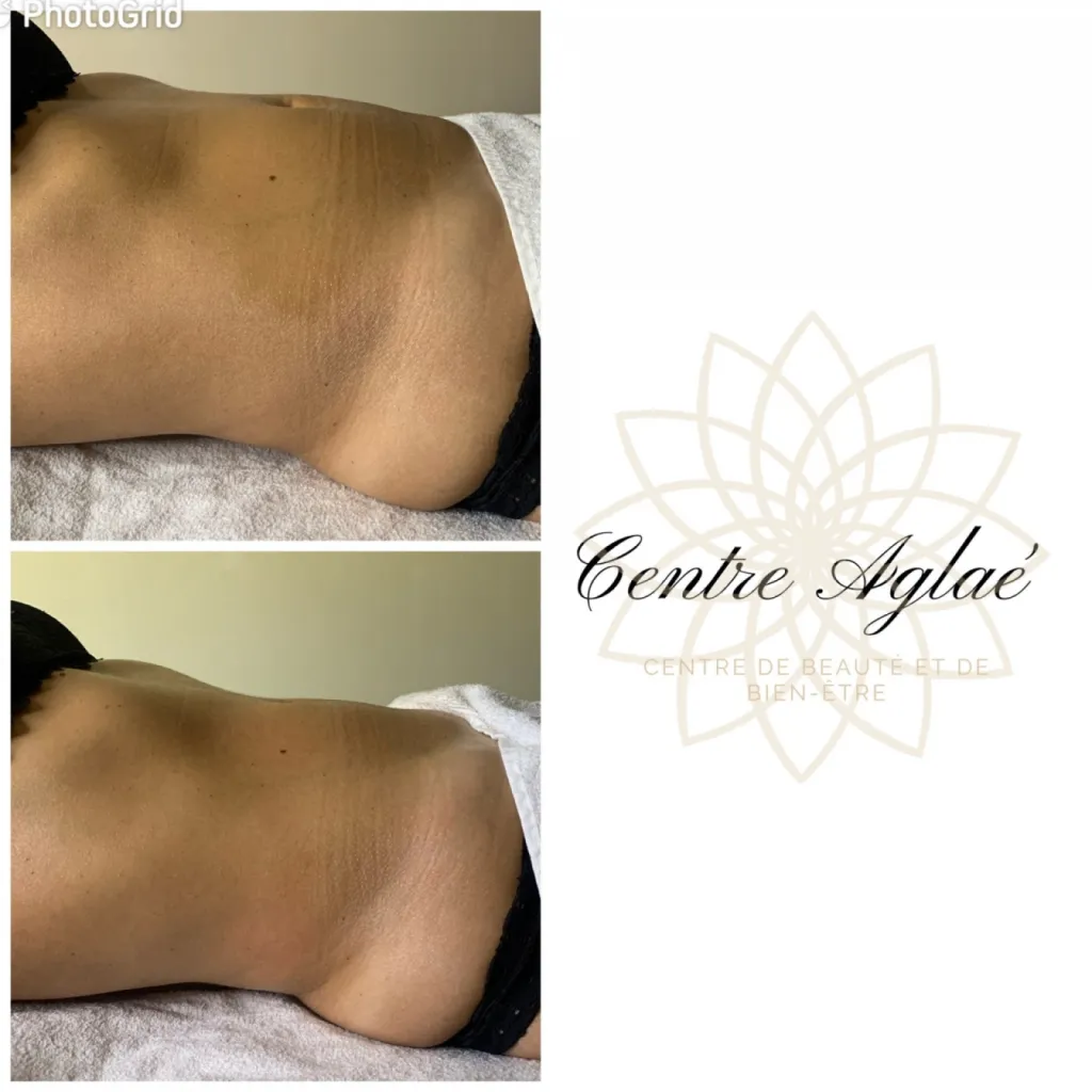 Le drainage lymphatique Renata Franca à Pertuis prêt d'Aix en Provence