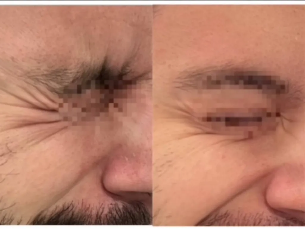 botox profhilo morpheus 