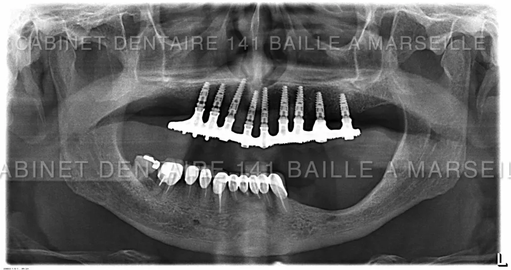 CAS DE MCI IMPLANTATION DENTAIRE  COMPLETE DOCTEUR DIDIER TOURROLIER