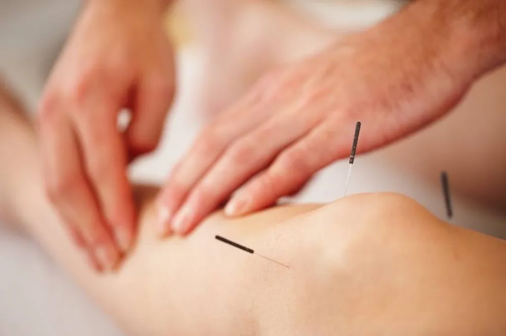 Le syndrome de Guillain-Barré traité par l'acupuncture à Lyon