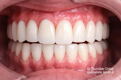 Spécialiste ALL ON 6 implantologie dentaire France