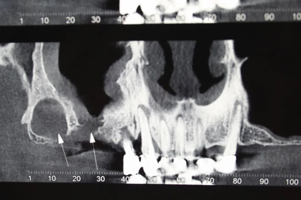 Technique Quattro ou all on four Dr Tourrolier didier Marseille