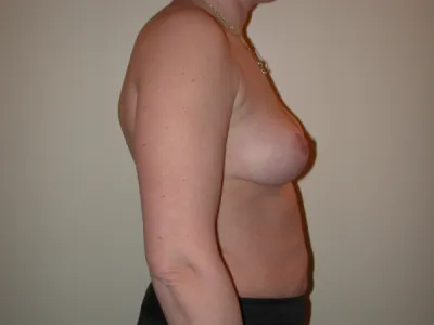 Correction de la ptose mammaire à Lyon : l’expertise du Dr Jean-François Pascal pour redonner galbe et projection à la poitrine