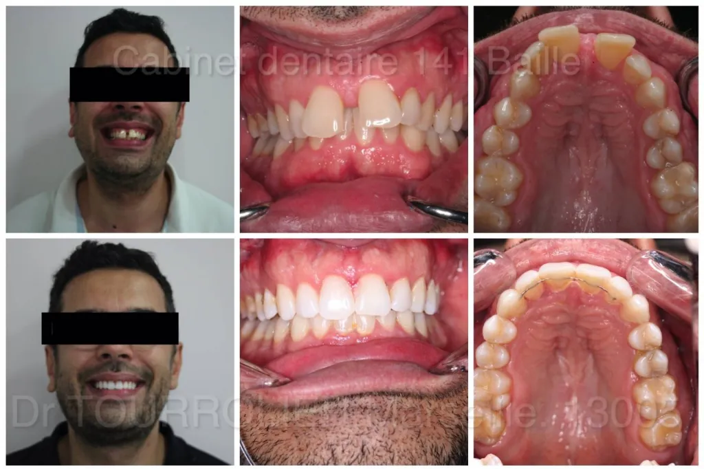 Notre zone d'activité pour ce serviceCoût traitement invisalign