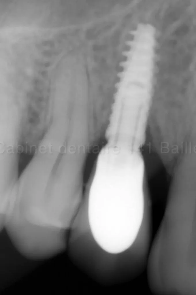 résultat de greffe d'os et pose d'implant en même temps 