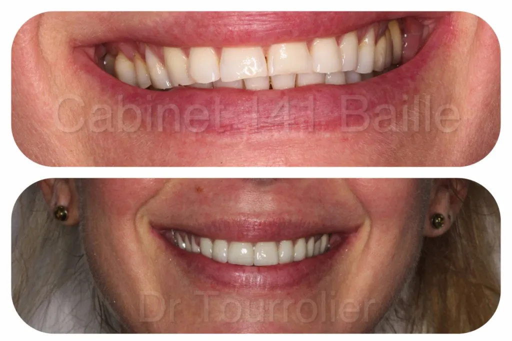 Restauration d'un sourire par facettes dentaires céramiques