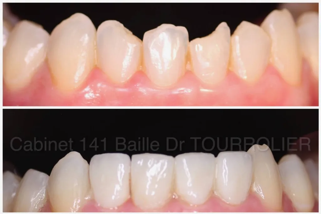 Dentiste pour facettes dentaires a marseille