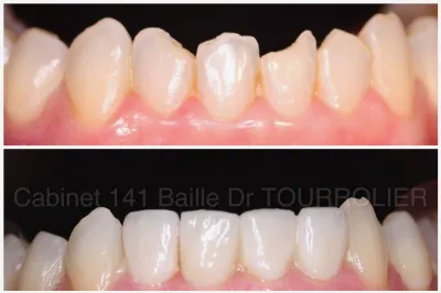 Dentiste pour facettes dentaires a marseille