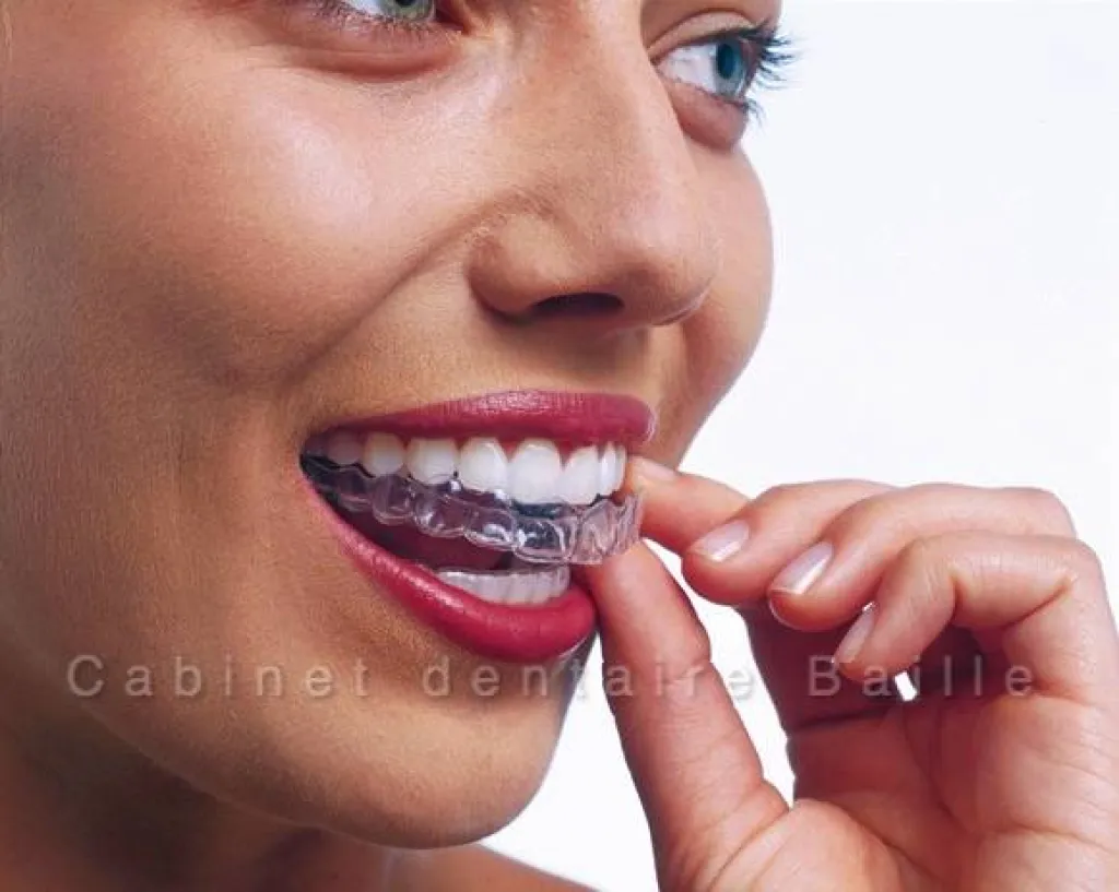 Améliorer son sourire avec la technique invisalign® -Dr TOURROLIER  Didier 141 bd Baille-13005 Masreille