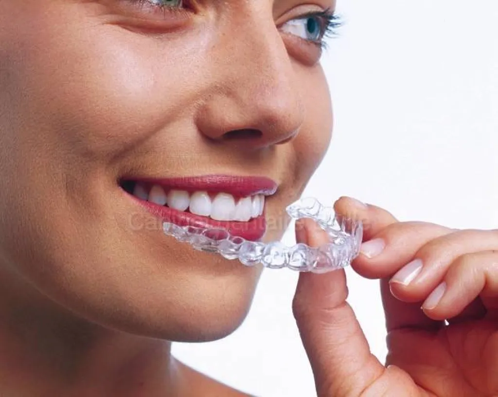 alignement des dents avec gouttieres transaparentes