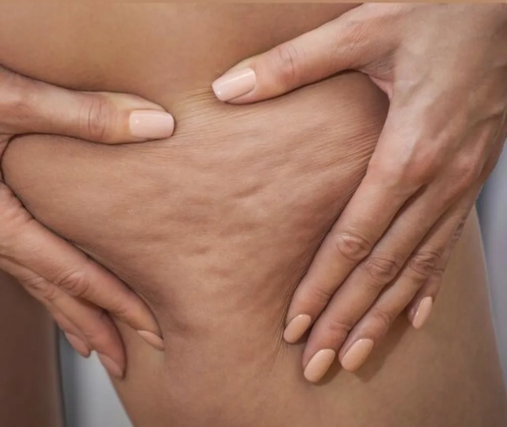 Lutter contre la cellulite avec le LPG 