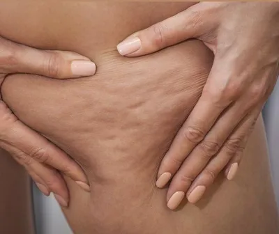 Lutter contre la cellulite avec le LPG 