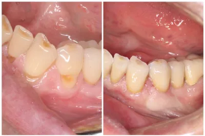 spécialiste facette dentaires céramique Marseille
