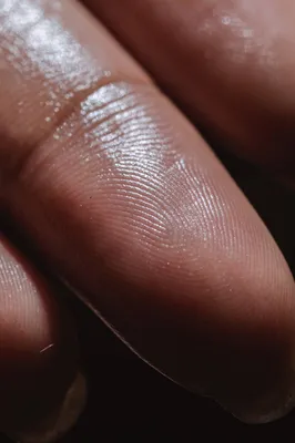 Hyperhidrose Marseille 13006