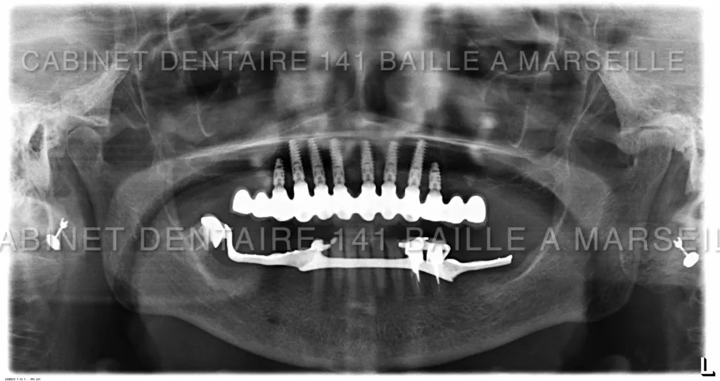 Implantation complète MCI